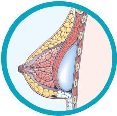 Breast after submuscular augmentation                                         